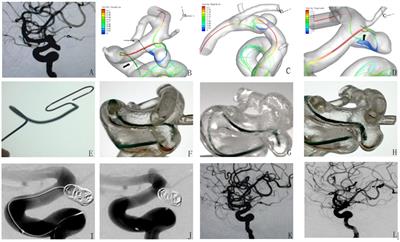 Application of microcatheter shaping based on computational fluid dynamics simulation of cerebral blood flow in the intervention of posterior communicating aneurysm of the internal carotid artery